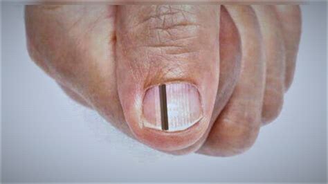 black lines in nails melanoma